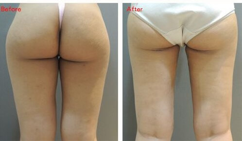 威塑抽脂術前術後曲線對比照