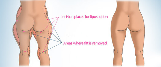 大腿抽脂重點區域圖示：包含馬鞍部、大腿內側與膝蓋內側