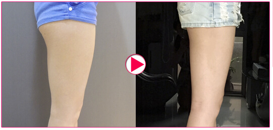 大腿抽脂術前術後側面對比