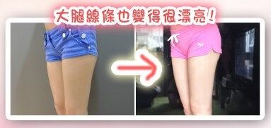 大腿抽脂術前術後側面對比