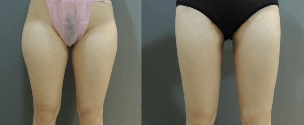 威塑大腿抽脂術前術後對比
