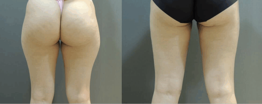 大腿抽脂恢復期線條變化