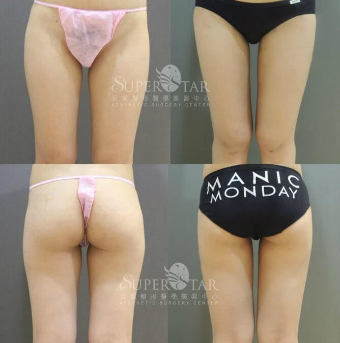 大腿抽脂案例6-曲線雕塑