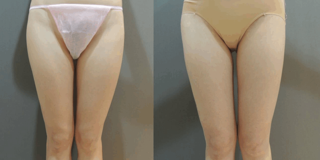 大腿抽脂案例7-全腿環繞效果