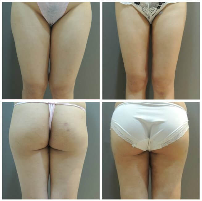 馬鞍臀部抽脂細節對比