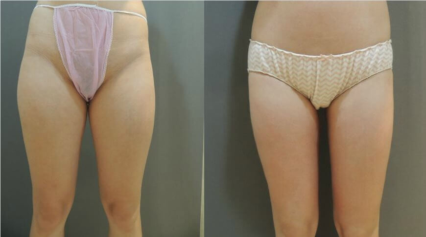 大腿抽脂案例4