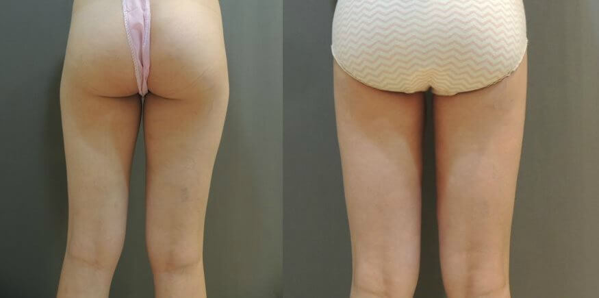 大腿抽脂案例4