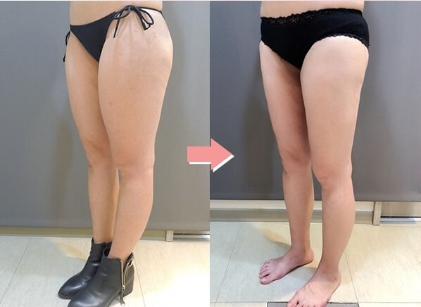 大腿抽脂案例5
