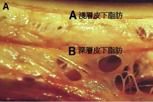 避免抽脂後「凹凸不平」，瞭解解剖構造是關鍵
