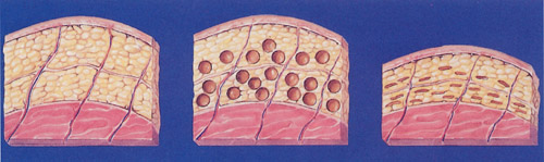 抽脂手術示意圖