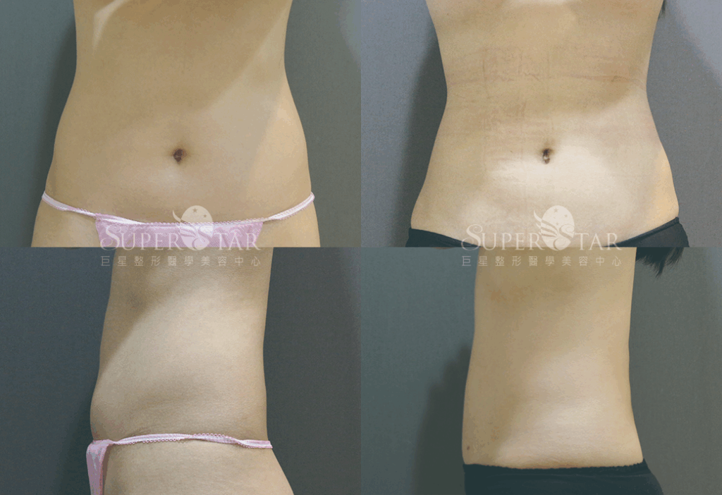 Case 2：威塑抽脂 - 腹部平坦術1