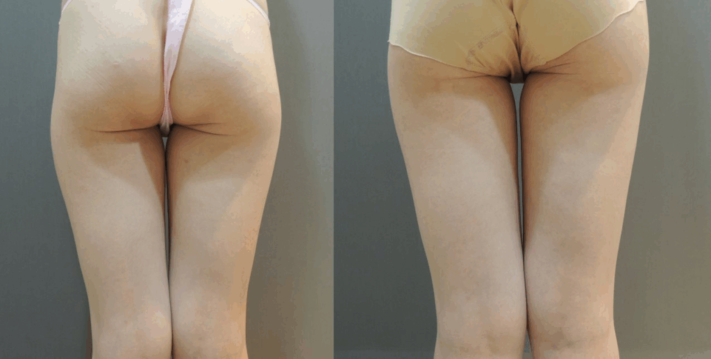 Case9 威塑抽脂 – 大腿抽脂, 環狀抽脂2