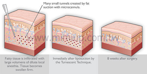 抽脂安全量建議圖