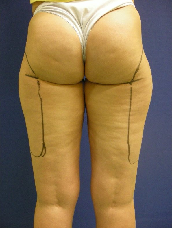 Case 6：產後雕塑水梨形身材 - 大腿環狀抽脂前