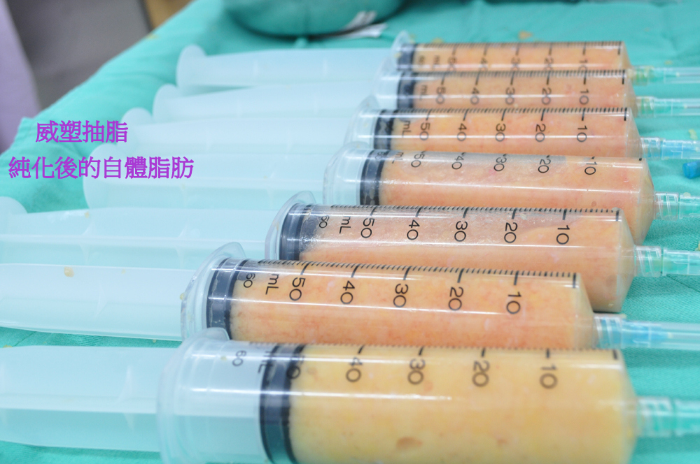 威塑抽脂醇化後的自體脂肪