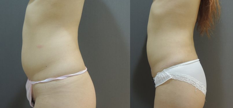 Case1 威塑抽脂 - 腹部抽脂, 肚子抽脂, 腰部抽脂2