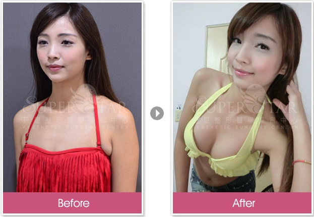 Case1 威塑 自體脂肪隆乳2