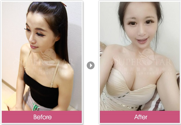 Case2 威塑抽脂 - 自體脂肪隆乳+自體脂肪豐頰+自體脂肪豐額1