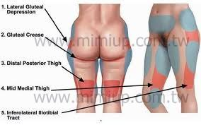 紅色區域為威塑抽脂須注意