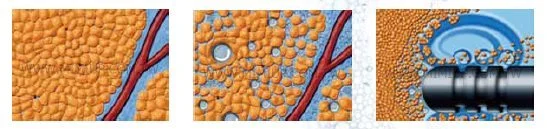 VASER 威塑抽脂 原理示意圖