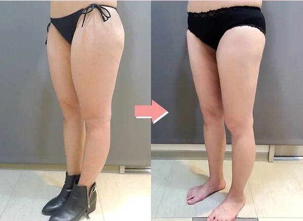 腿部抽脂3,對比照