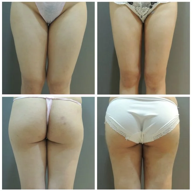 腿部抽脂4,對比照