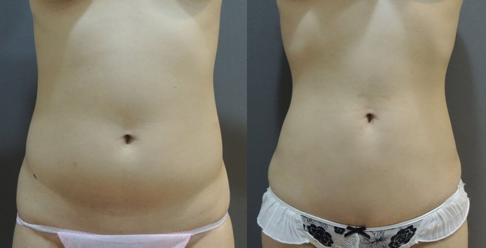 Case 1: 腹部環抽 (消除大肚腩)1