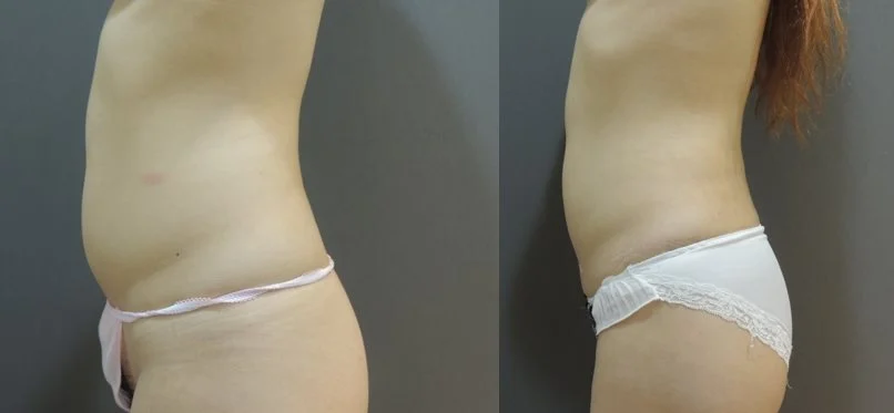 Case 1: 腹部環抽 (消除大肚腩)2