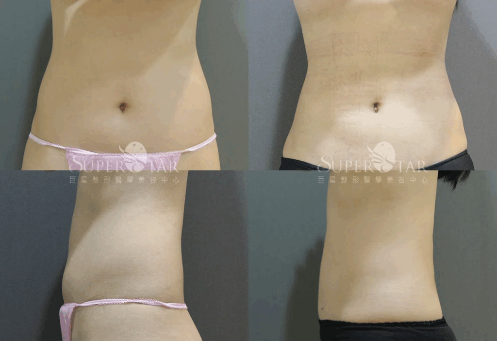 Case2 威塑抽脂 – 腹部抽脂, 肚子抽脂, 腰腹抽脂