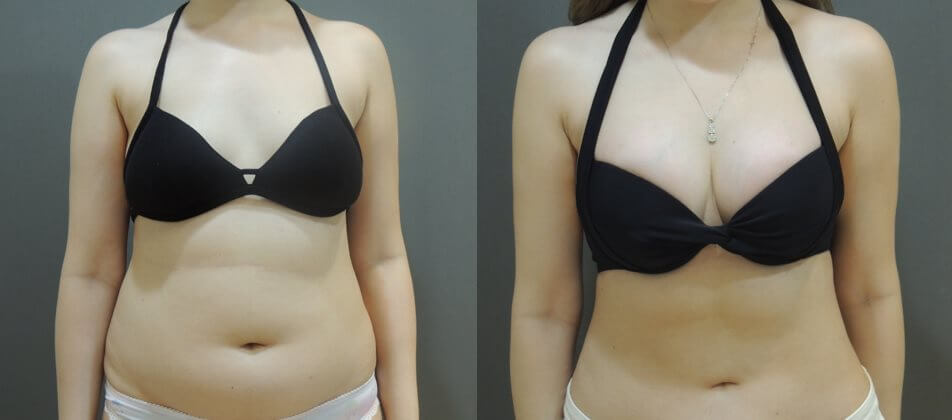 Case 4: 腰腹環抽 + 果凍矽膠隆乳 (複合式手術)1