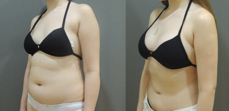 Case 4: 腰腹環抽 + 果凍矽膠隆乳 (複合式手術)2