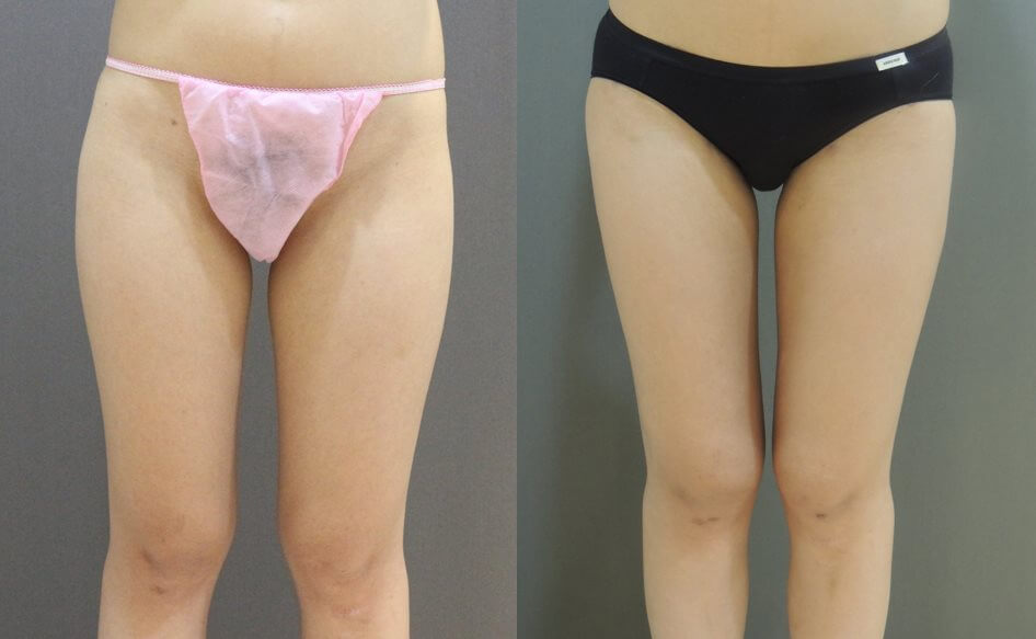 Case7 威塑抽脂 – 腿部抽脂, 大腿抽脂 + 膝蓋抽脂1