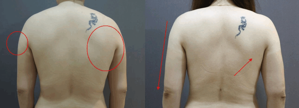 手臂抽脂 + 後副乳抽脂 + 後背抽脂 - 改善虎背熊腰