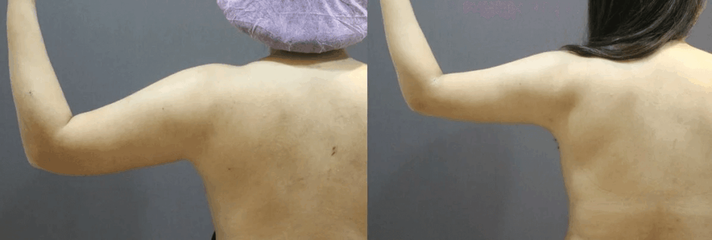 手臂抽脂合併後副乳抽脂案例