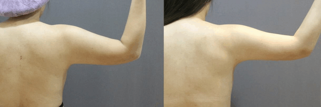 手臂抽脂合併後副乳抽脂案例