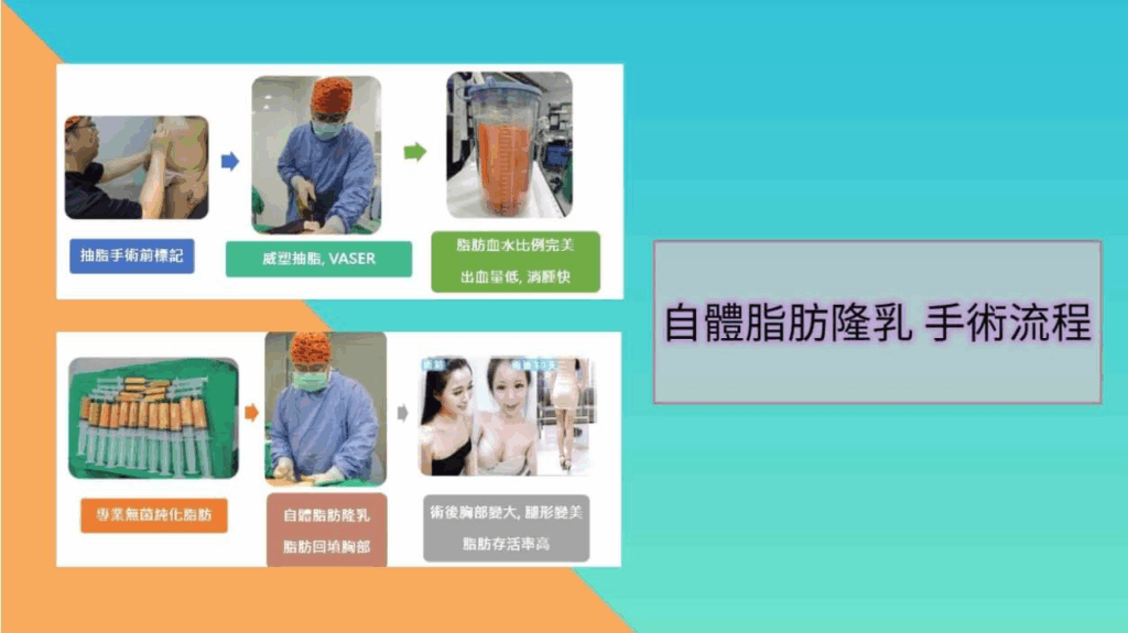 自體脂肪隆乳SOP
