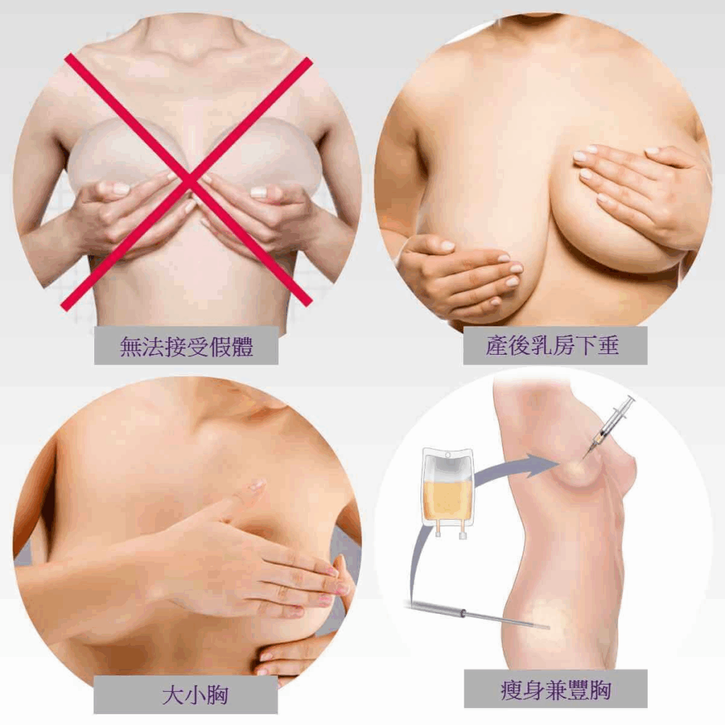 適合自體脂肪的族群