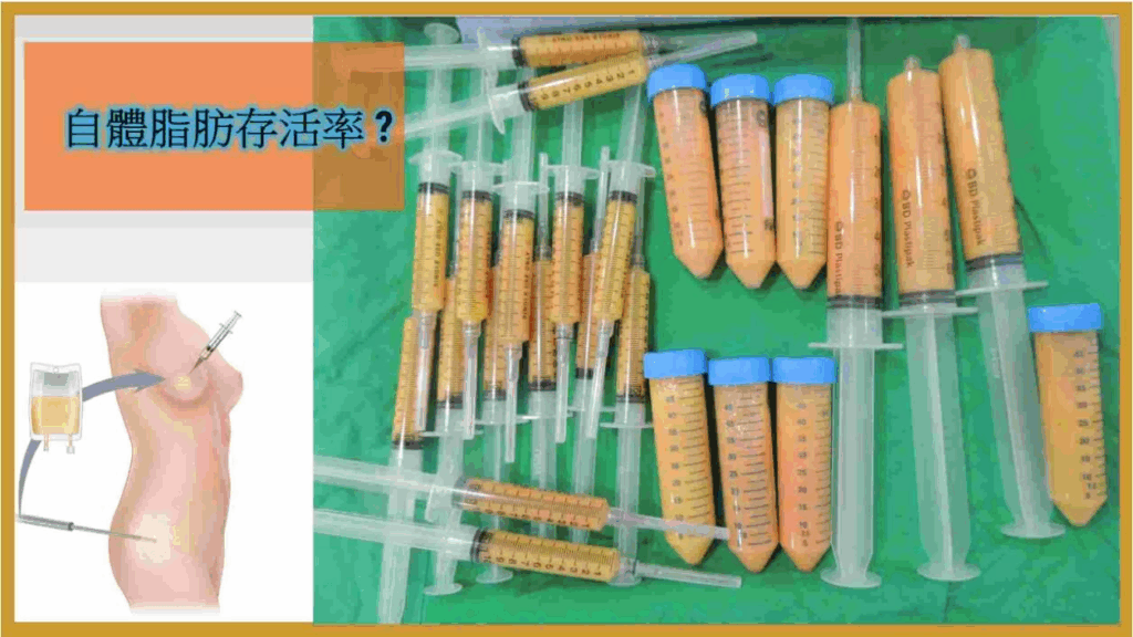 自體脂肪示意圖