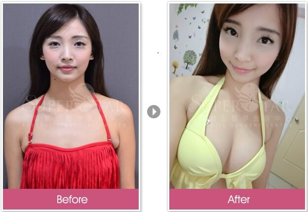 Case 1：威塑自體脂肪隆乳2