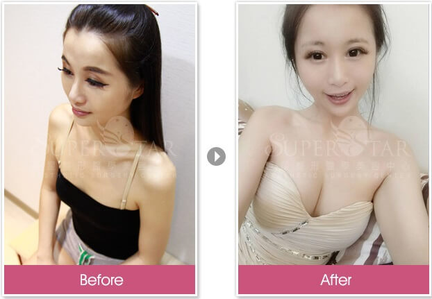 Case 2：威塑抽脂 - 自體脂肪隆乳 + 豐頰 + 豐額1