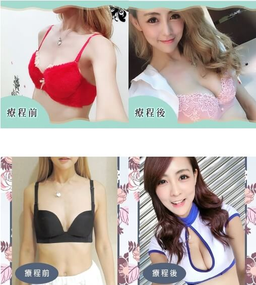 Case 3：威塑自體脂肪隆乳1