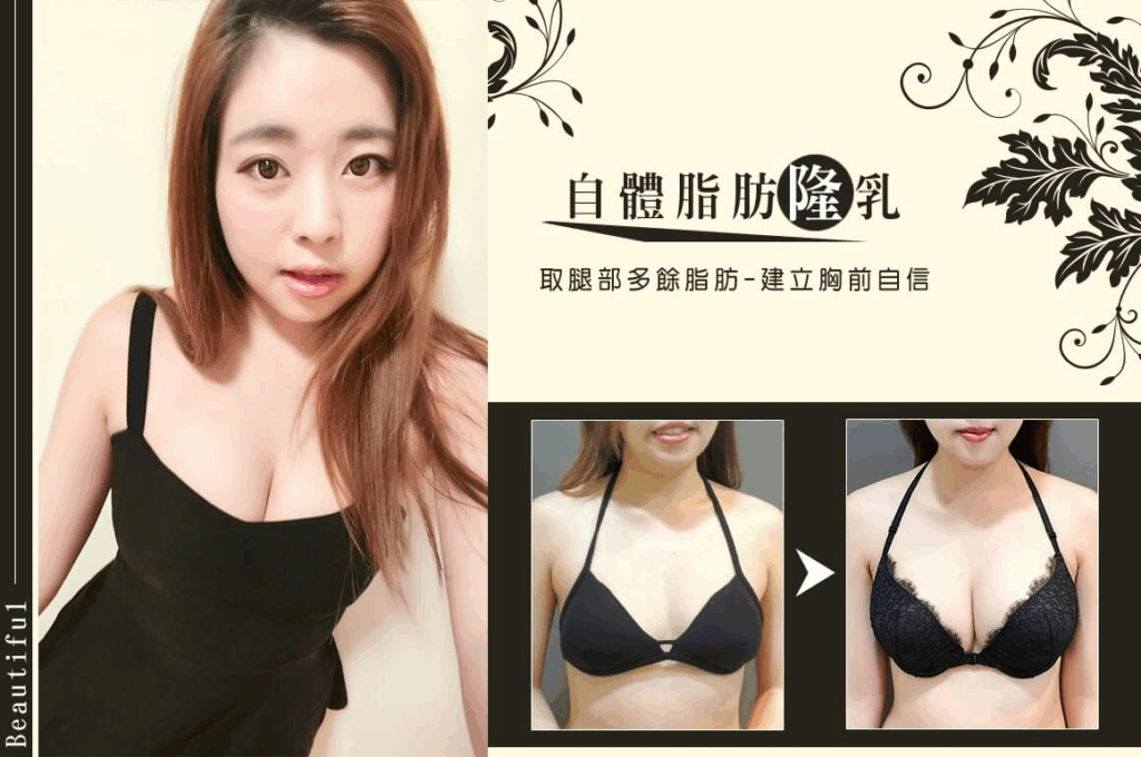 Case 5：威塑自體脂肪隆乳1