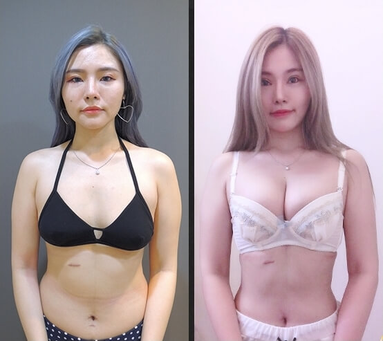 案例分享2-正面對比照