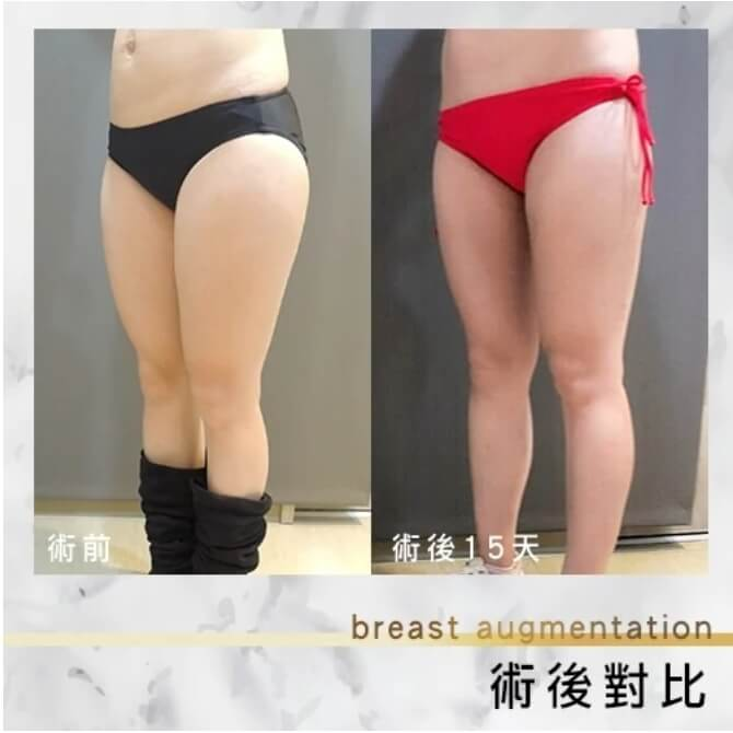 案例分享6 術後15天照片