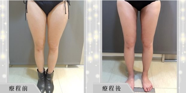 案例分享7 腿部對比前後照片