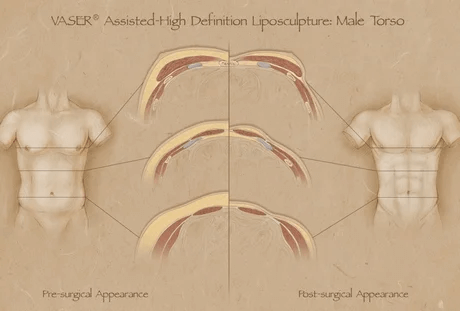 威塑抽脂 (VASER) 與 4D 威塑體雕 的優勢