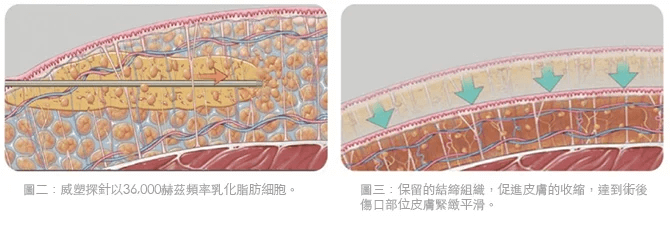 空穴效應 (Cavitation) 使脂肪乳糜化