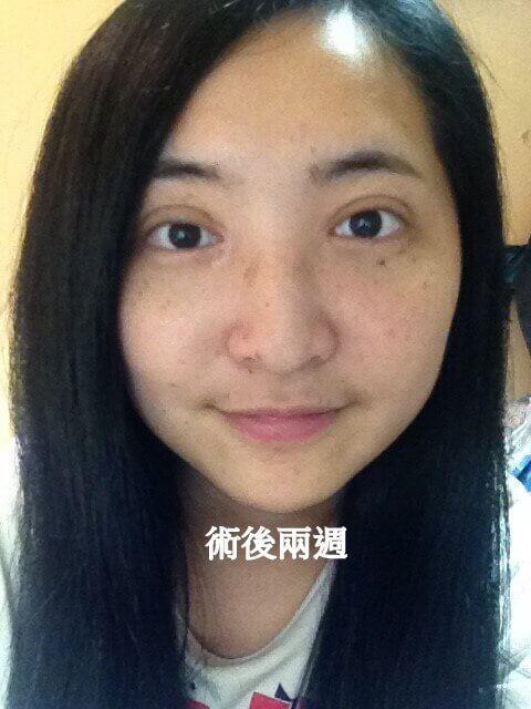 術後兩周照片