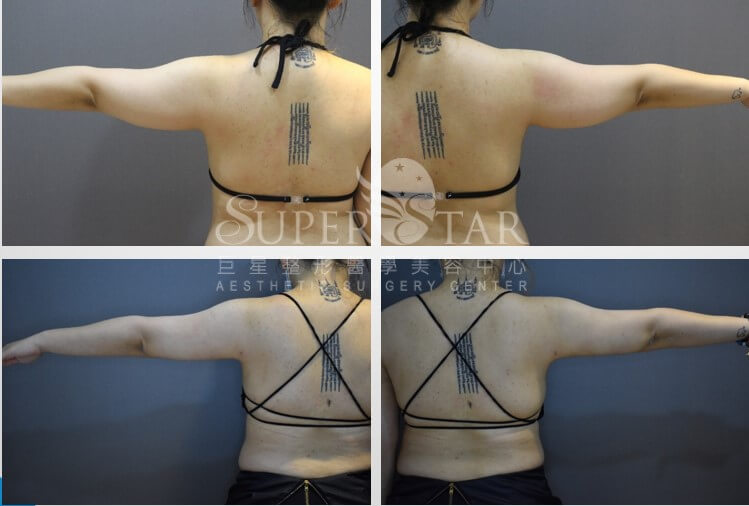 Case1 複合式電漿抽脂 - 手臂