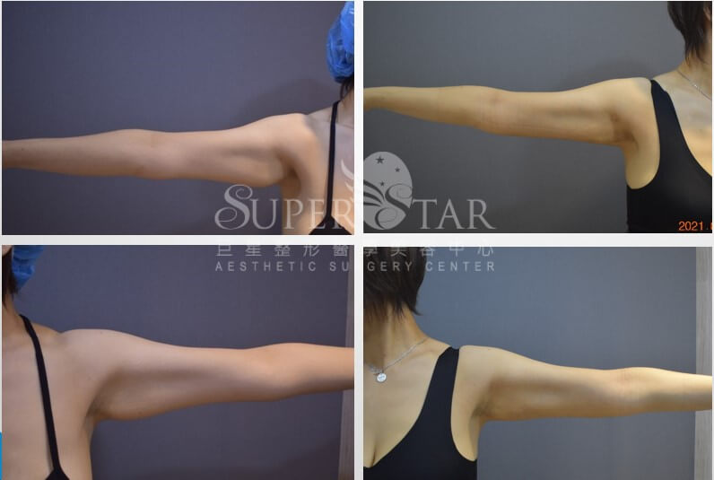 Case2 複合式電漿抽脂 - 手臂